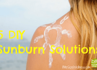 Treating Sunburns