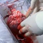 Heart-Transplant-Procedure