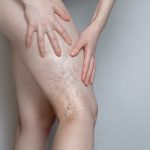 Woman shows leg with varicose veins. The concept of human health and disease. Gray background